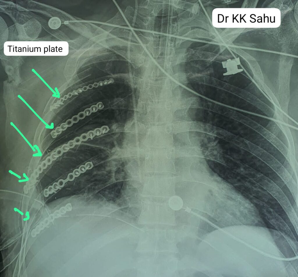 सड़क दुर्घटना में बुजुर्ग की पसली हो गई थी चकनाचूर, टाइटेनियम प्लेट की नयी पसली बनाकर बचाई जान