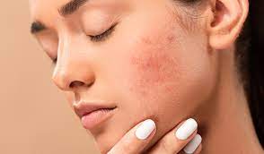 ऐसे करें अपनी Acne Prone Skin की देखभाल: जानिए घरेलू नुस्खे