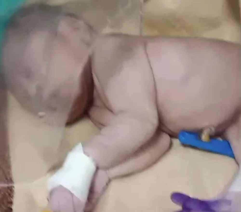 भैंसदेही सीएचसी में जन्मे एक शिशु को देखते ही सब लोग हैरान, बच्चे के पैर किसी जलपरी की तरह जुड़े