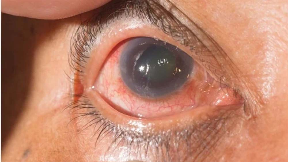 किसी को भी हो सकती है आंखों की बीमारी काला मोतिया किसी को भी हो सकती है आंखों की बीमारी काला मोतिया