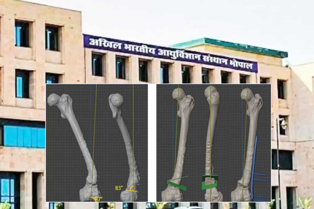 भोपाल एम्स ने हासिल की एक और बड़ी उपलब्धि, 3 डी प्रिंटिंग तकनीक से होगा हड्डी रोग का निशुल्क इलाज