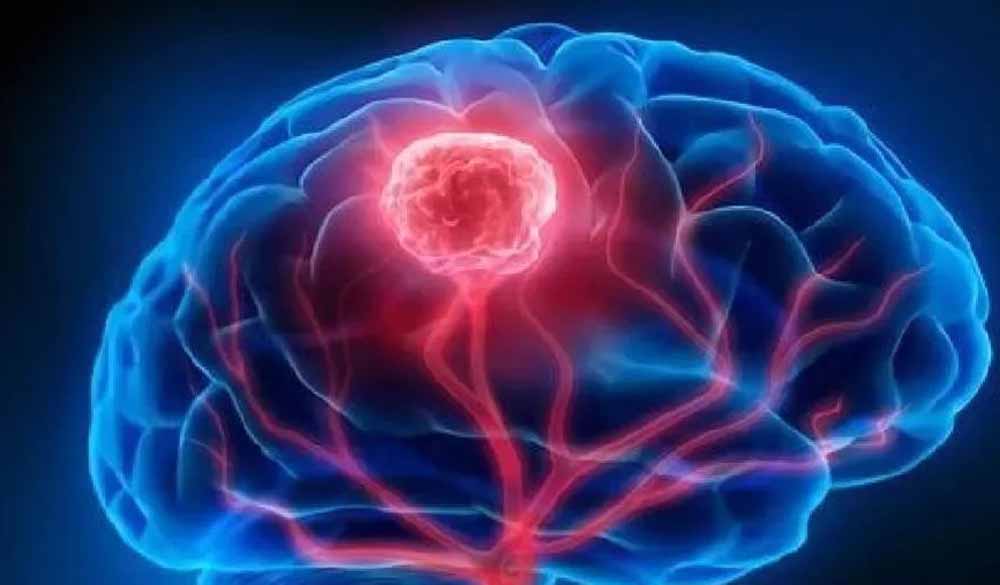 ब्रेन ट्यूमर अब नहीं है लाइलाज, नई तकनीक से सफल इलाज, बीमारी के प्रति फैल रही जागरूक ब्रेन ट्यूमर अब नहीं है लाइलाज, नई तकनीक से सफल इलाज, बीमारी के प्रति फैल रही जागरूक