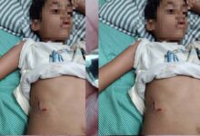 पेबल बे फेस 1, बागमुगलिया कटारा हिल्स में आवारा कुत्ते ने बच्चे को काटा