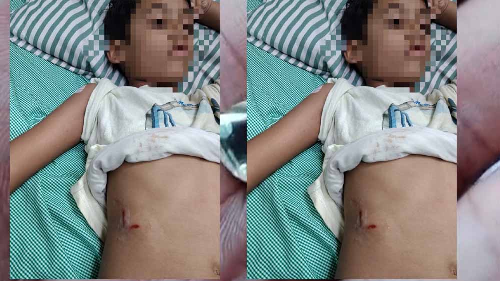 पेबल बे फेस 1, बागमुगलिया कटारा हिल्स में आवारा कुत्ते ने बच्चे को काटा पेबल बे फेस 1, बागमुगलिया कटारा हिल्स में आवारा कुत्ते ने बच्चे को काटा