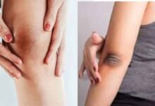 ऐसे दूर करें कोहनी और घुटनों के कालेपन को
