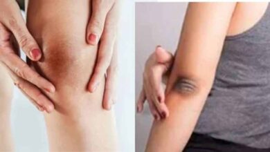 ऐसे दूर करें कोहनी और घुटनों के कालेपन को