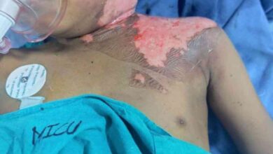 भिलाई के कैंप के झुलसे दिव्यांश की सर्जरी के लिए विधायक रिकेश ने की पहल