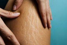 क्या सच में नारियल तेल मिटा सकता है स्ट्रेच मार्क्स? डर्मेटोलॉजिस्ट ने बताया सच