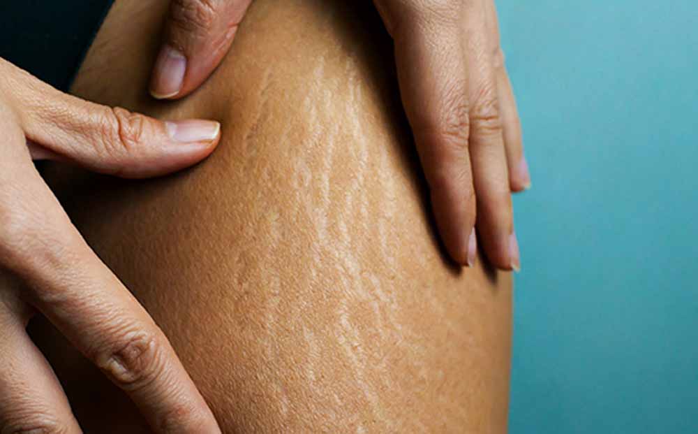 क्या सच में नारियल तेल मिटा सकता है स्ट्रेच मार्क्स? डर्मेटोलॉजिस्ट ने बताया सच