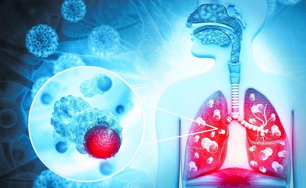 हर 9 में से 1 भारतीय को कैंसर का खतरा, पुरुषों में फेफड़े और महिलाओं में ब्रेस्ट कैंसर सबसे ज्यादा हर 9 में से 1 भारतीय को कैंसर का खतरा, पुरुषों में फेफड़े और महिलाओं में ब्रेस्ट कैंसर सबसे ज्यादा