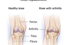 क्या हेल्थ इंश्योरेंस में नी रिप्लेसमेंट सर्जरी कवर की जाती है,जानिए