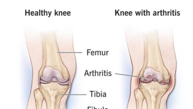 क्या हेल्थ इंश्योरेंस में नी रिप्लेसमेंट सर्जरी कवर की जाती है,जानिए क्या हेल्थ इंश्योरेंस में नी रिप्लेसमेंट सर्जरी कवर की जाती है,जानिए