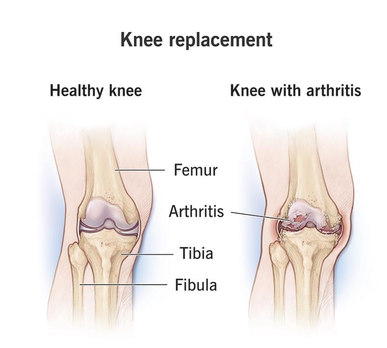 क्या हेल्थ इंश्योरेंस में नी रिप्लेसमेंट सर्जरी कवर की जाती है,जानिए क्या हेल्थ इंश्योरेंस में नी रिप्लेसमेंट सर्जरी कवर की जाती है,जानिए