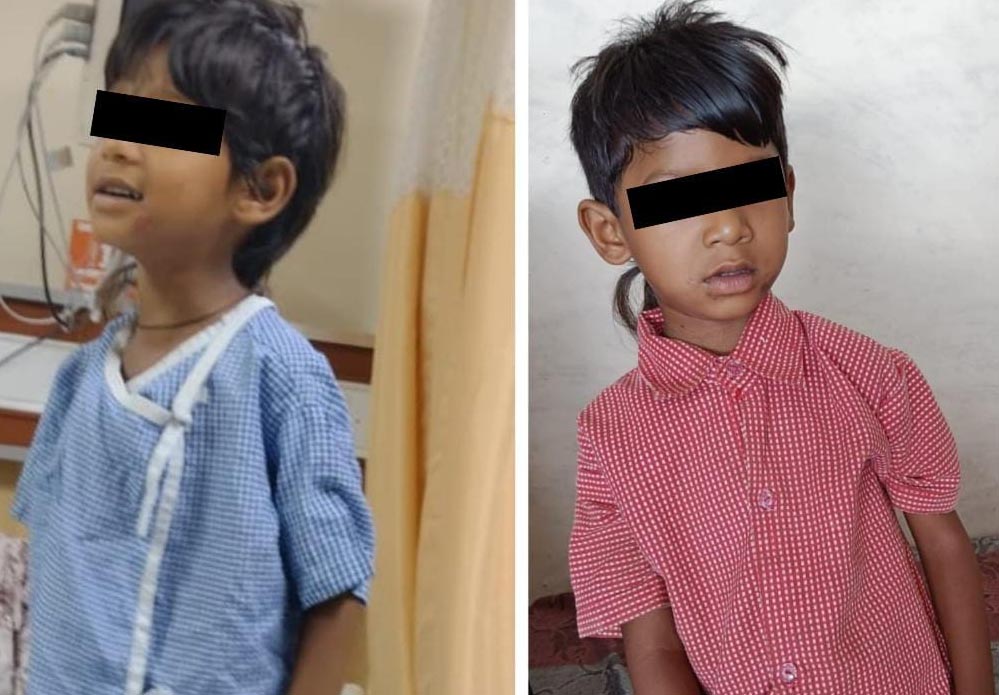 रायपुर : चिरायु योजना से नित्या राजवाड़े को मिला नया जीवन