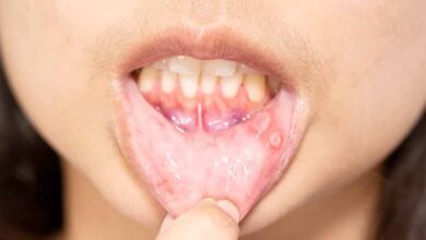 मुंह के छालों से राहत पाने के आसान और असरदार घरेलू उपाय