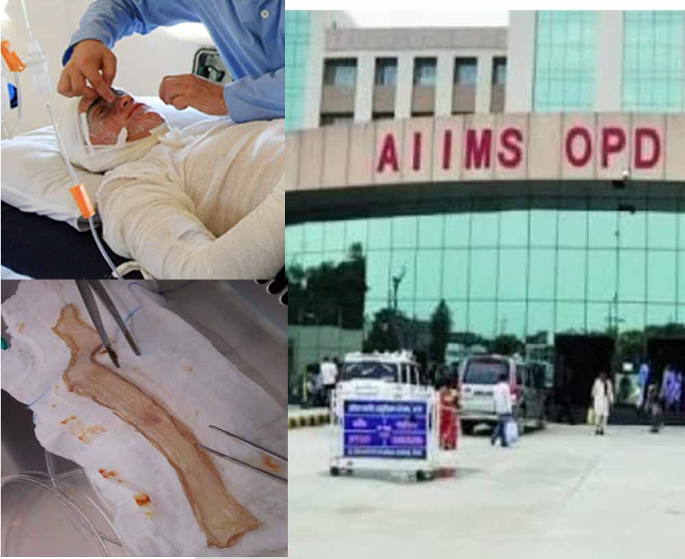 बिहार का पहला स्किन बैंक तैयार, पटना एम्स में जलने वाले मरीजों को अब मिलेगा नया जीवन