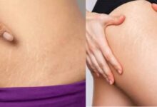 घर बैठे ऐसे मिटाएँ जिद्दी स्ट्रेच मार्क्स, बिना महंगे इलाज के