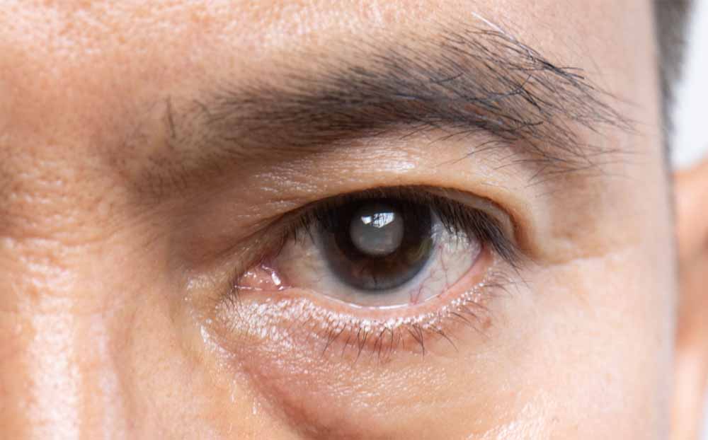 साइलेंट चोर ‘ग्लूकोमा’ से सावधान! आंखों में दिखें ये संकेत तो तुरंत कराएं जांच