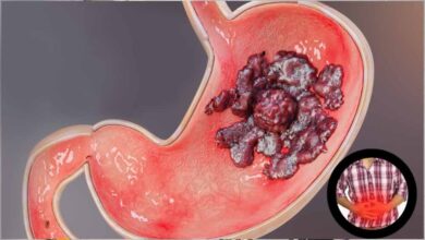 अल्सर से कैसा डर! जानिए इलाज और बचाव के आसान तरीके