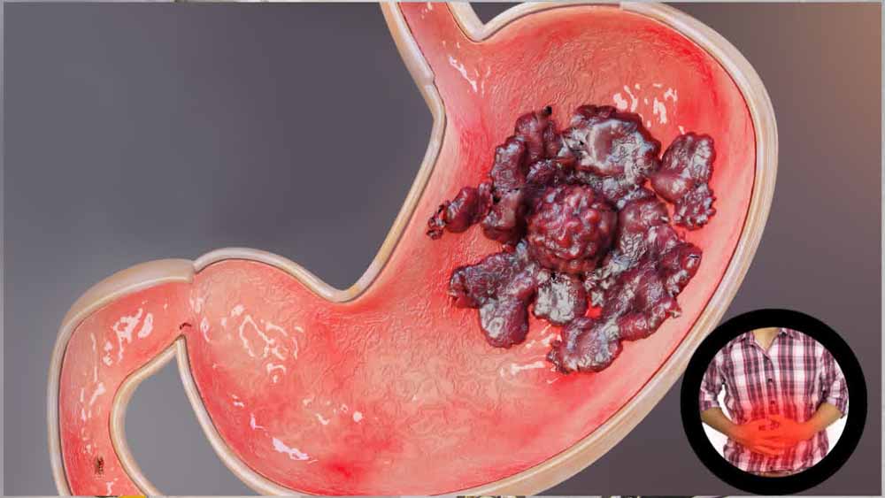 अल्सर से कैसा डर! जानिए इलाज और बचाव के आसान तरीके अल्सर से कैसा डर! जानिए इलाज और बचाव के आसान तरीके