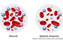 सिर्फ एनीमिया नहीं, जानलेवा भी हो सकता है एप्लास्टिक एनीमिया — आम खून की कमी से कितना अलग है यह रोग?