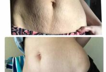 घर बैठे जिद्दी स्ट्रेच मार्क्स हटाने के आसान और असरदार तरीके