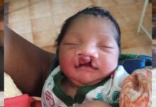 जब चिरायु टीम बनी एक परिवार की उम्मीद, जन्मजात विकृति से जूझ रहे बच्चे को मिला नया जीवन