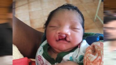 जब चिरायु टीम बनी एक परिवार की उम्मीद, जन्मजात विकृति से जूझ रहे बच्चे को मिला नया जीवन