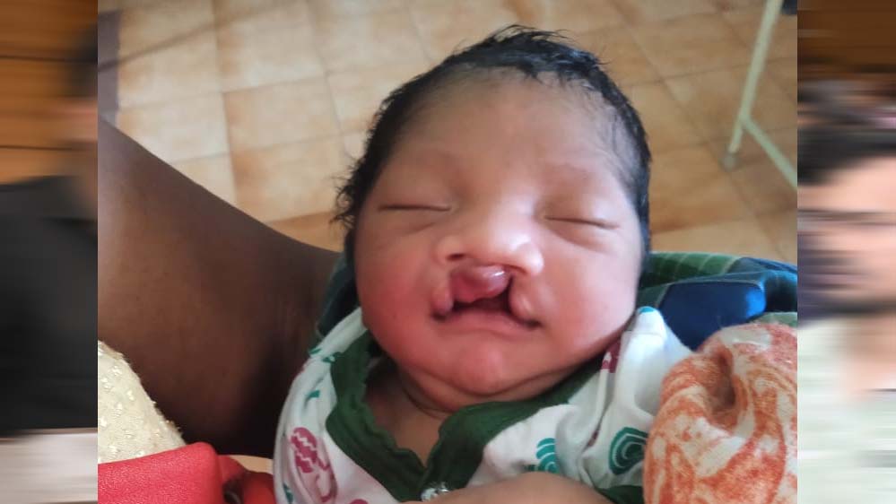 जब चिरायु टीम बनी एक परिवार की उम्मीद, जन्मजात विकृति से जूझ रहे बच्चे को मिला नया जीवन जब चिरायु टीम बनी एक परिवार की उम्मीद, जन्मजात विकृति से जूझ रहे बच्चे को मिला नया जीवन