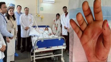 डॉक्टरों ने बच्ची का कटा हाथ जोड़ा, एम्स पटना में 6 घंटे चली सर्जरी