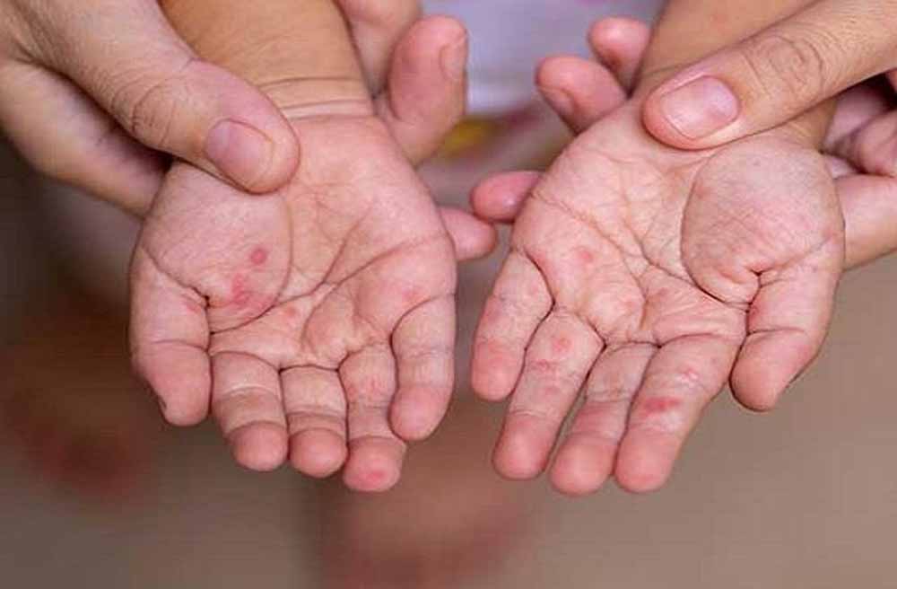 MP में खसरे की दस्तक: 4 जिलों में मिले 12 नए मरीज, स्वास्थ्य विभाग अलर्ट पर