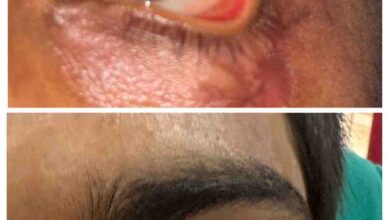 स्किन ग्राफ्टिंग से मरीज के पलक का सफल पुनर्निर्माण,युवक को नई दृष्टि और सामान्य जीवन की ओर लौटने का मिला अवसर