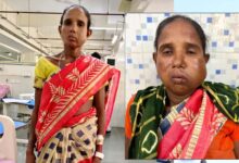 रायपुर: संजीवनी बना मेगा सुपर स्पेशलिटी हेल्थ कैंप, बुधरी मड़कम को मिला नया जीवन