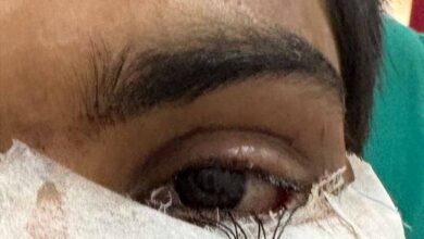 स्किन ग्राफ्टिंग से मरीज के पलक का सफल पुनर्निर्माण