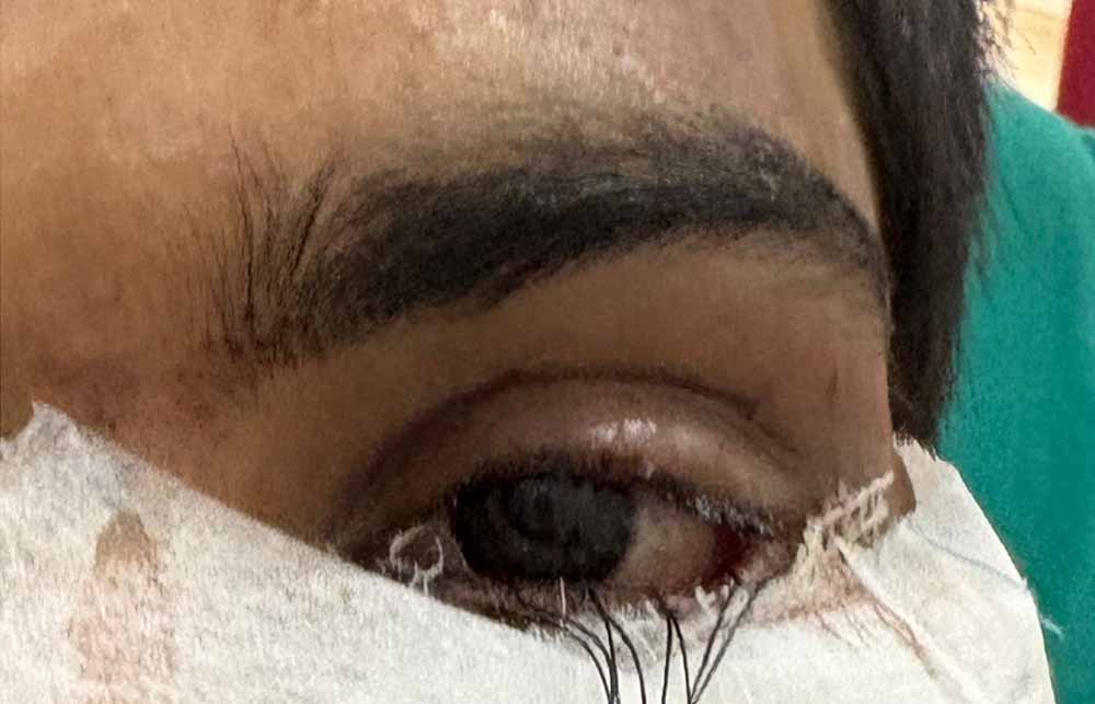 स्किन ग्राफ्टिंग से मरीज के पलक का सफल पुनर्निर्माण स्किन ग्राफ्टिंग से मरीज के पलक का सफल पुनर्निर्माण