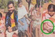 पत्थर शरीर वाली बच्ची के उपचार को लेकर बाल आयोग सक्रिय