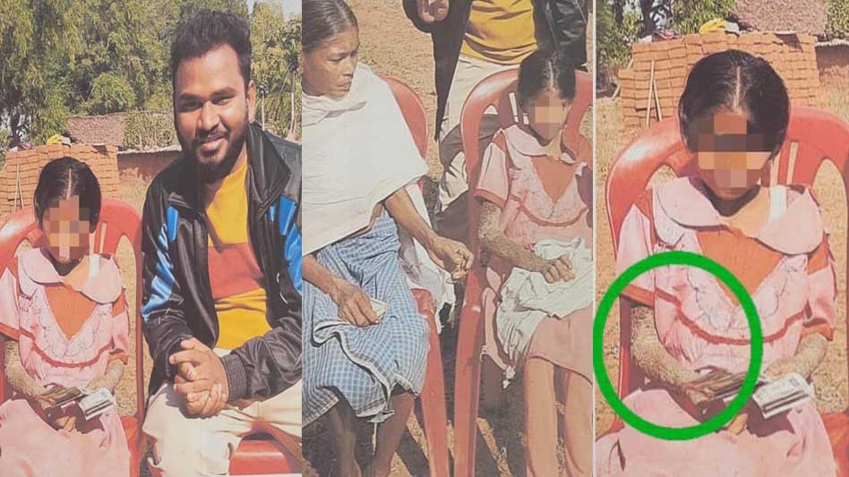 पत्थर शरीर वाली बच्ची के उपचार को लेकर बाल आयोग सक्रिय पत्थर शरीर वाली बच्ची के उपचार को लेकर बाल आयोग सक्रिय