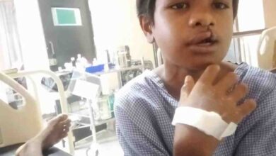 ‘चिरायु’ दल ने लौटाई मुस्कान, जन्मजात कटे होंठ और तालु से मिली मुक्ति