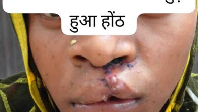सफल सर्जरी से भीमे हेमला के चेहरे पर लौटी मुस्कान,जन्मजात होंठ की विकृति का हुआ सफल उपचार, अब सामान्य जीवन जी रही हैं 22 वर्षीय युवती सफल सर्जरी से भीमे हेमला के चेहरे पर लौटी मुस्कान,जन्मजात होंठ की विकृति का हुआ सफल उपचार, अब सामान्य जीवन जी रही हैं 22 वर्षीय युवती