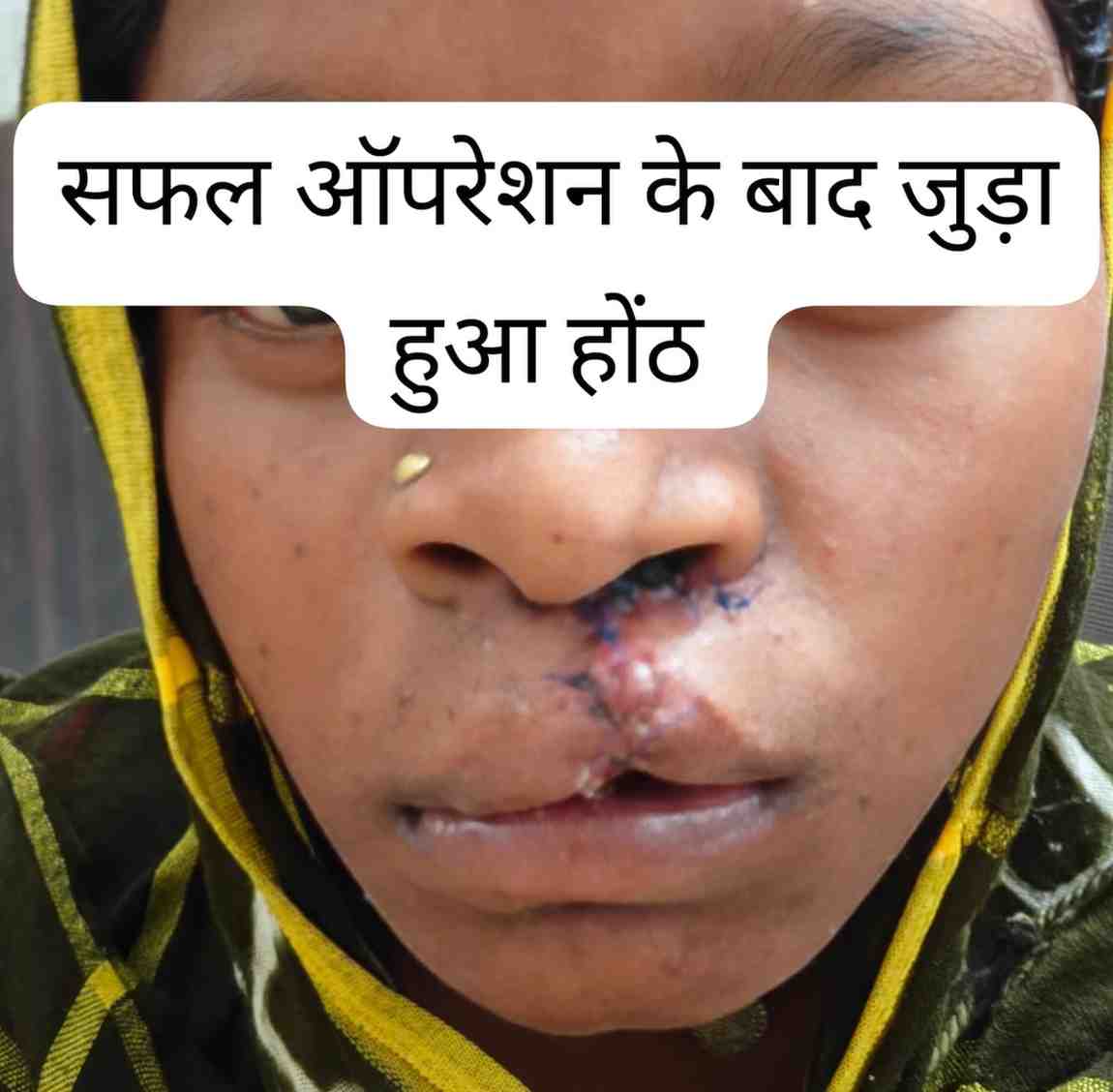 सफल सर्जरी से भीमे हेमला के चेहरे पर लौटी मुस्कान,जन्मजात होंठ की विकृति का हुआ सफल उपचार, अब सामान्य जीवन जी रही हैं 22 वर्षीय युवती
