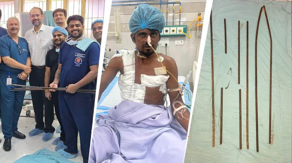 शरीर में आर-पार घुसे 4 लोहे के सरिये, KGMU के डॉक्टरों ने साढ़े आठ घंटे की सर्जरी से बचाई मजदूर की जान शरीर में आर-पार घुसे 4 लोहे के सरिये, KGMU के डॉक्टरों ने साढ़े आठ घंटे की सर्जरी से बचाई मजदूर की जान