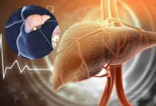 Fatty Liver को न करें नजरअंदाज! बढ़ सकता है हार्ट अटैक का खतरा, दिखें ये लक्षण तो तुरंत जाएं डॉक्टर के पास