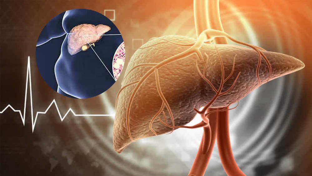 Fatty Liver को न करें नजरअंदाज! बढ़ सकता है हार्ट अटैक का खतरा, दिखें ये लक्षण तो तुरंत जाएं डॉक्टर के पास