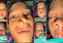 चिरायु योजना से जन्मजात समस्या से मिली राहत, तीन बच्चों के चेहरों पर लौटी मुस्कान