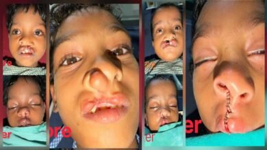 चिरायु योजना से जन्मजात समस्या से मिली राहत, तीन बच्चों के चेहरों पर लौटी मुस्कान चिरायु योजना से जन्मजात समस्या से मिली राहत, तीन बच्चों के चेहरों पर लौटी मुस्कान