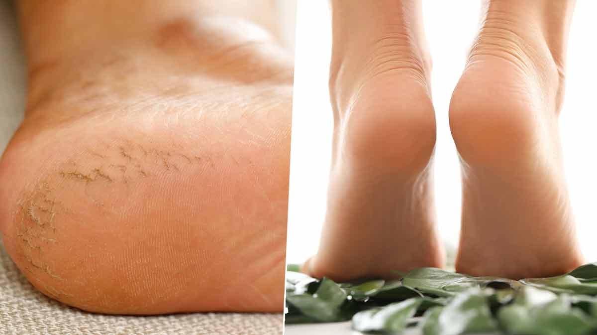 फटी एड़ियों से छुटकारा पाने के 5 घरेलू उपाय, केला-शहद से लेकर वैसलीन तक आएंगे काम फटी एड़ियों से छुटकारा पाने के 5 घरेलू उपाय, केला-शहद से लेकर वैसलीन तक आएंगे काम